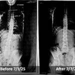 before after indira 1