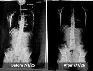 Scoliosis